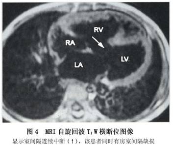 小儿室间隔缺损