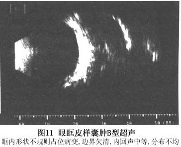 眼眶皮样囊肿