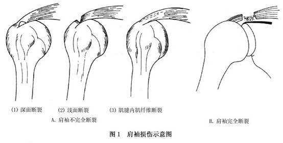 肩袖损伤按损伤程度可分为挫伤,不完全断裂及完全断裂3类(图1.