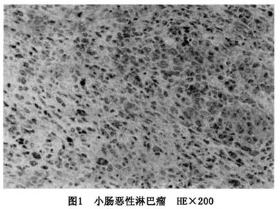 大多数肠道淋巴瘤是全身性淋巴瘤的一种局部表现,目前认为psil的诊断