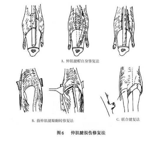 手部伸肌腱损伤
