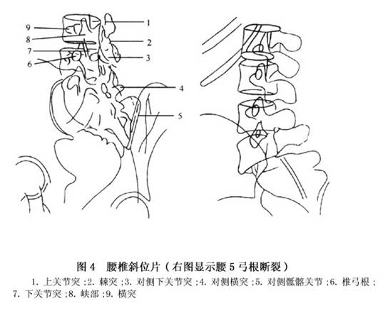 狗颈——椎弓峡部或关节突间部.     身体——同侧椎板.