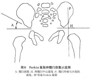 然而,个别患儿的髋关节脱位在外展,内旋位有自然复位的可能,结果表现