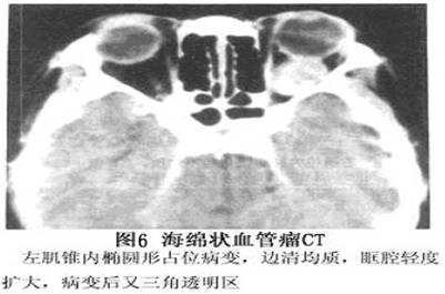 眼眶内海绵状血管瘤