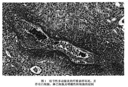 急性期血管炎症损伤的特点主要表现为纤维素样坏死和多种细胞的浸润