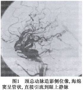 直接型颈动脉海绵窦瘘