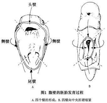 脐膨出