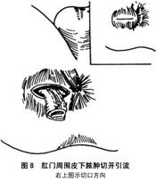 肛管直肠周围脓肿