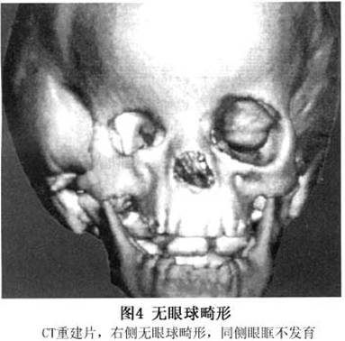 先天性小眼球合并眼眶囊肿