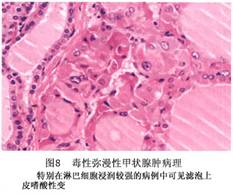 ③多数滤泡含有胶质,滤泡上皮呈明显的乳头状突起;④类似于正常甲状腺