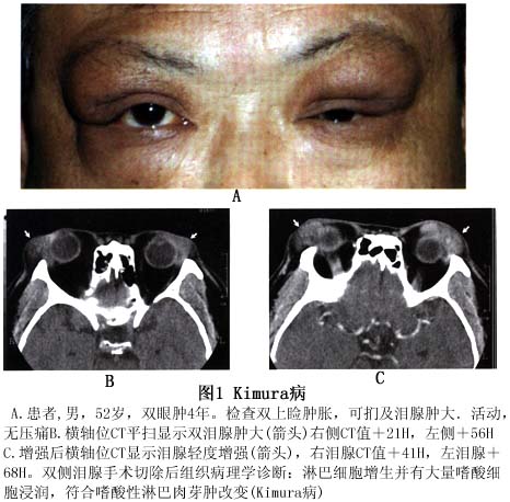 病变主要累及泪腺,侵犯泪腺时使