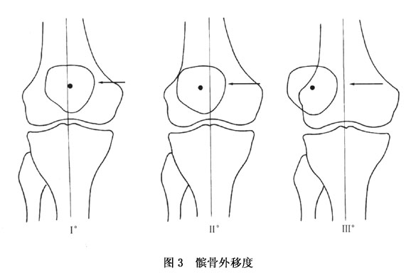 (8)髌骨外移度增加或关节松弛:正常人膝关节在伸直位时髌骨被动