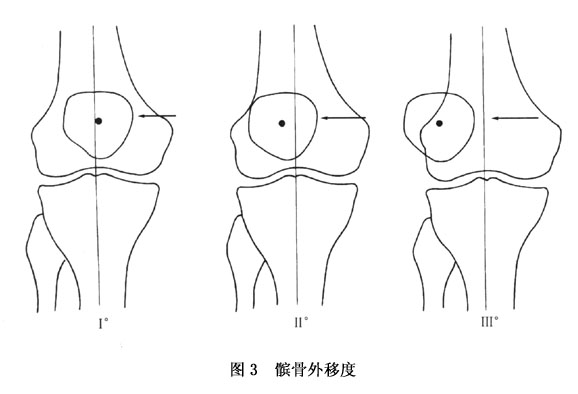 (9)q角异常:q角是衡量髌骨力线的重要指标,股骨内旋和胫骨外旋可