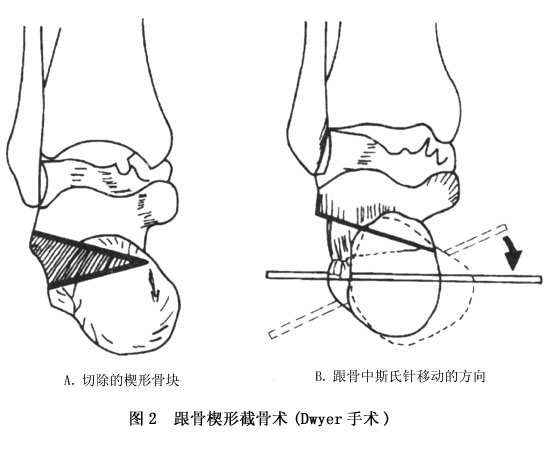 关节融合术 多采用跗部三关节融合术,适用于10～12岁以上畸形严重的