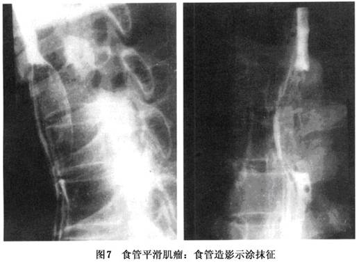 食管平滑肌瘤