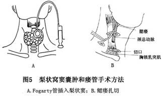 鳃裂囊肿和瘘