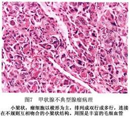 甲状腺瘤