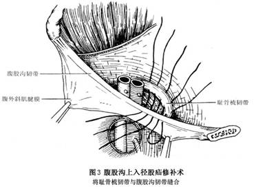 股疝的修补是将腹股沟韧带,骼耻束,陷窝韧带与耻骨梳韧带缝合以