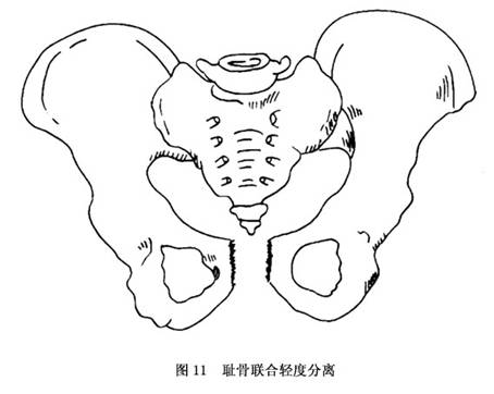 ⑦骶髂关节半脱位:此种损伤虽属骨盆环一处损伤,但损伤是位于