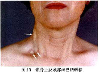②锁骨上淋巴结:一般继腋窝淋巴结之后发生,转移淋巴结多位于
