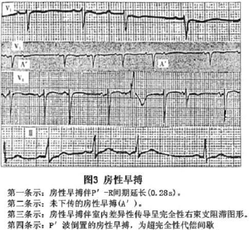 房性早搏