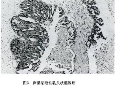 卵巢浆液性肿瘤