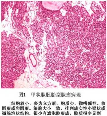甲状腺瘤