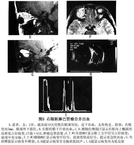 眼眶淋巴管瘤