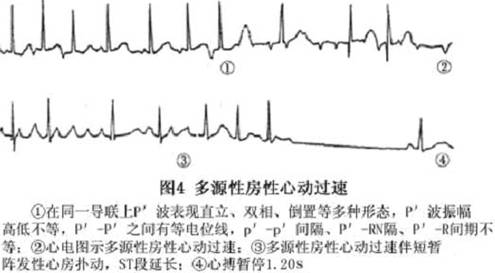 紊乱性房性心动过速的疾病介绍 挂号网