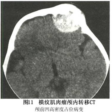 眼眶横纹肌肉瘤