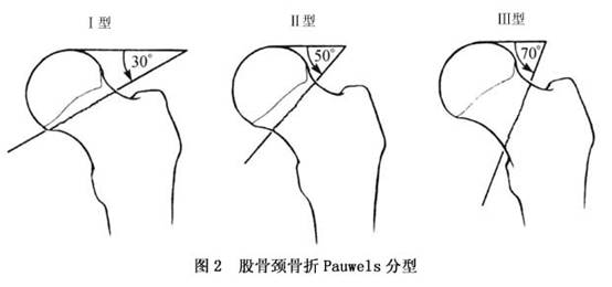 股骨颈骨折