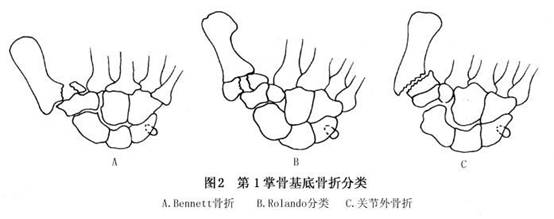 第一掌骨基底部骨折脱位