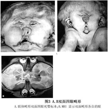 先天性小眼球合并眼眶囊肿