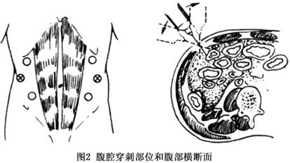 闭合性腹腔灌洗 在排空膀胱后,于脐至耻骨联合间连线上的上1/3处,用