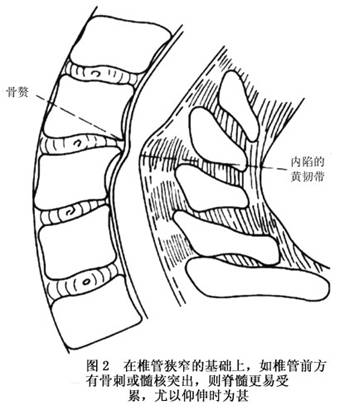 颈椎椎管狭窄症