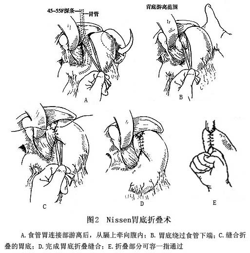 婴幼儿胃食管反流