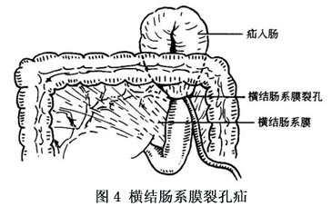 小网膜囊疝