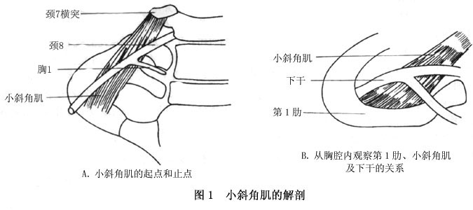 胸廓出口综合征