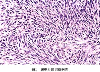 腹壁纤维肉瘤