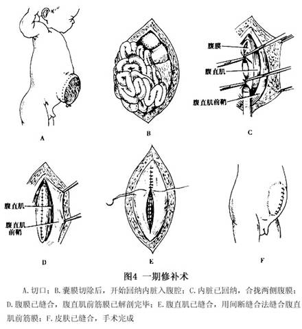 脐膨出