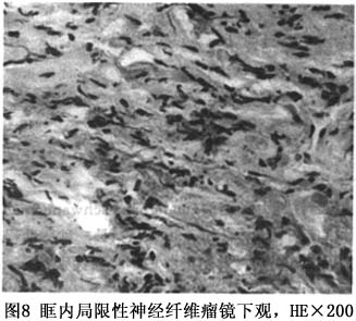 疾病百科 疾病介绍      丛状神经纤维瘤(plexiform neurofibroma)