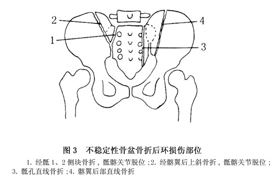 以上4类不稳定骨盆骨折的后环损伤部位,都在骶髂关节或其邻近,其