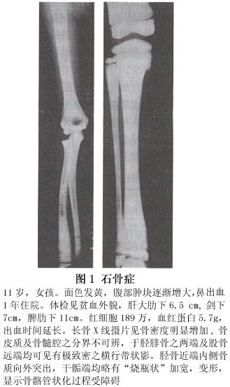 小儿骨硬化病