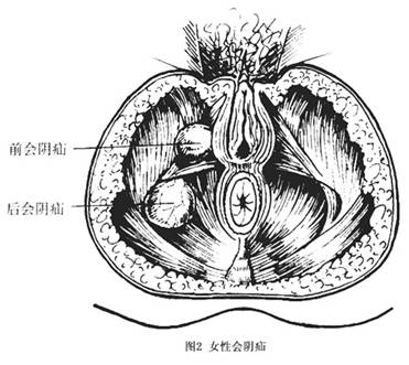 会阴疝