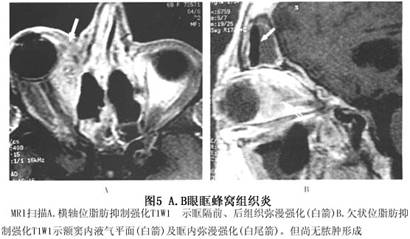 眼眶蜂窝织炎