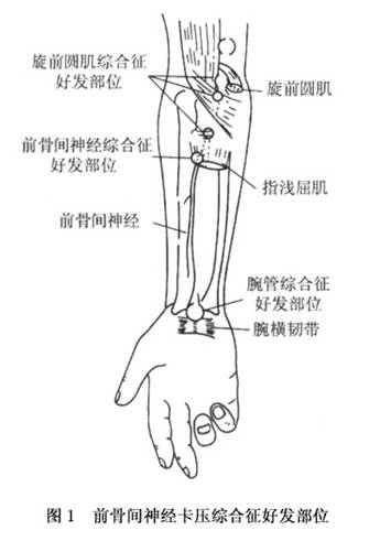 前骨间神经卡压综合征