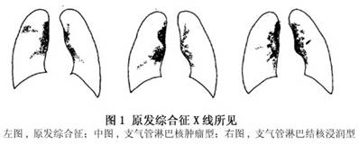 (1)原发复合征:典型表现为肺内原发病灶,肺门淋巴结肿大,连结前