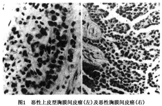 恶性间皮瘤/diffuse pleural endotheliomas-疾病概述