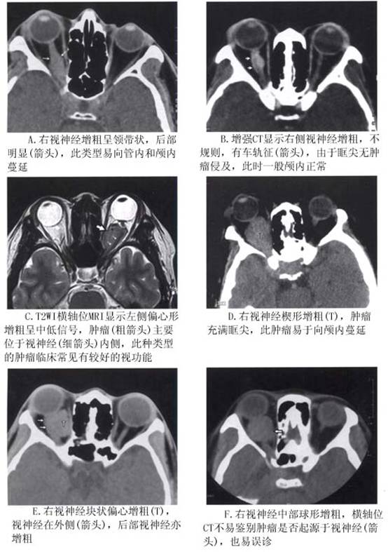 ct扫描 ct对视神经肿瘤的诊断尤其是肿瘤内的钙化显示非常有价值.