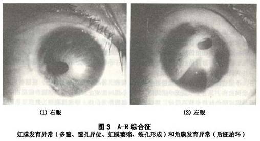 阿克森费尔德-里格尔综合征